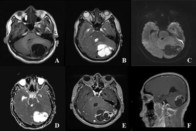 Cystic intracranial solitary fibrous tumor: a case report